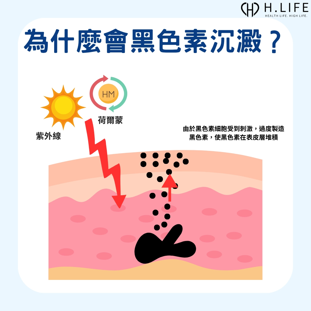 為什麼會黑色素沉澱？